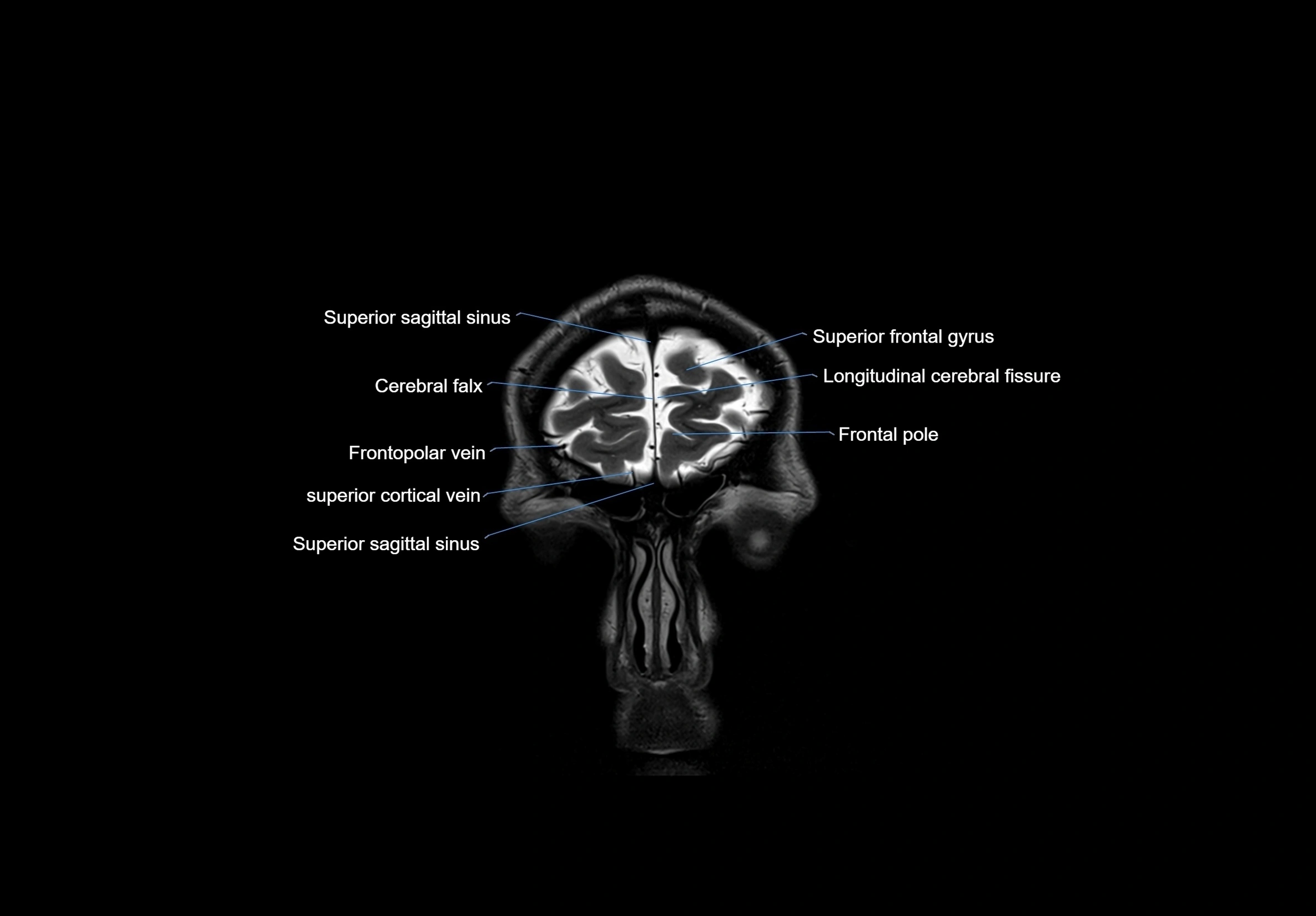 MRI Brain coronal cross sectional labelled anatomy 3T image  -img-00001-00007.webp